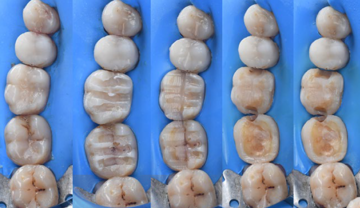 Fig. 2: Restoration of two molars: Teeth preparation and caries excavation.